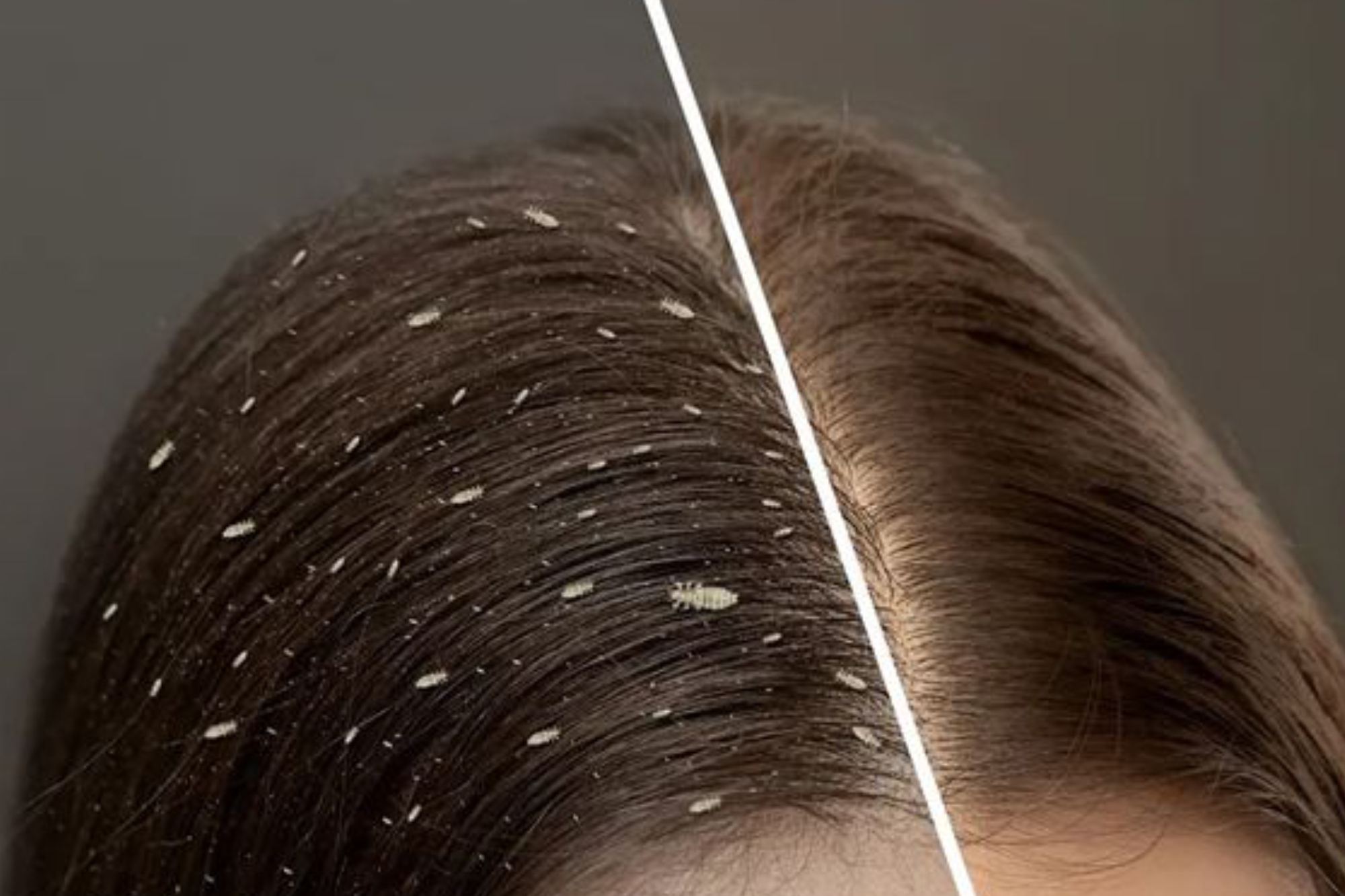 Effective Home Remedies To Get Rid Of Lice Naturally